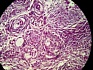Метастазирование раковых клеток: новое исследование
